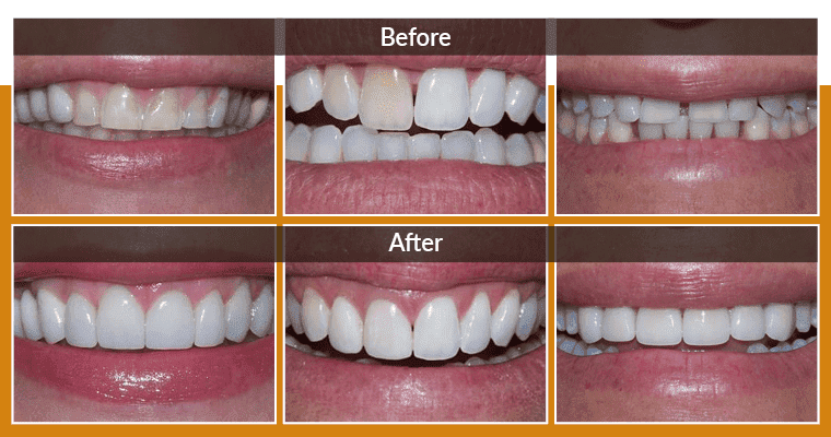 Veneers After 10 Years