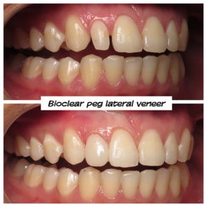 Veneers Alternative