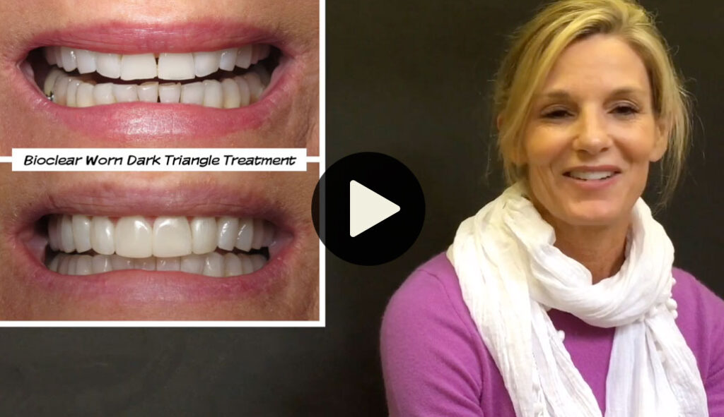 Veneers Alternative