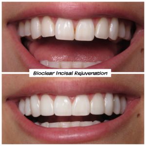 Veneers Alternative