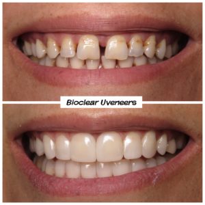 Veneers Alternative