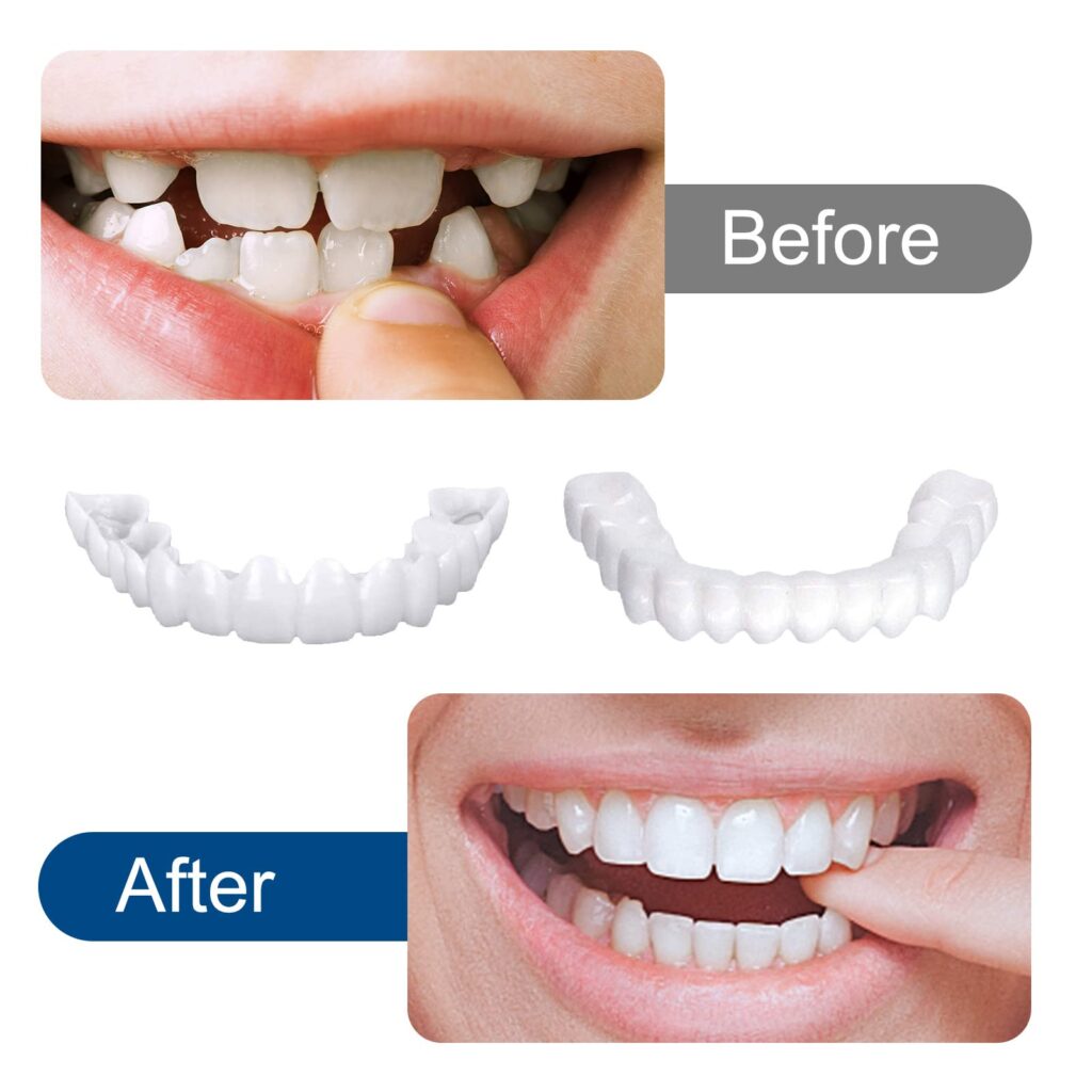 Veneers Amazon