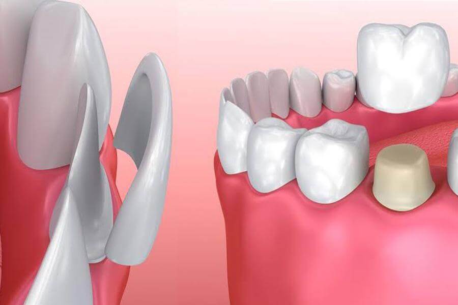 Veneers And Crowns
