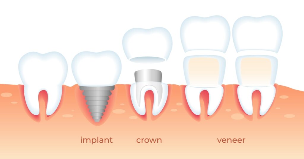 Veneers And Crowns