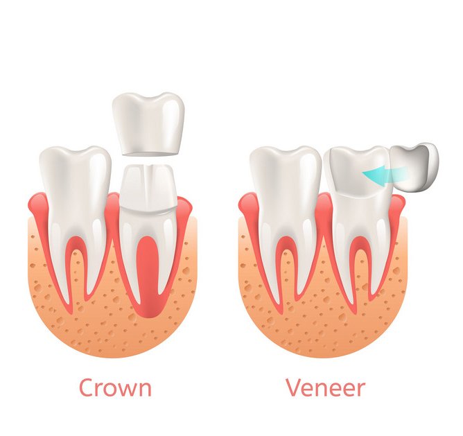Veneers And Crowns