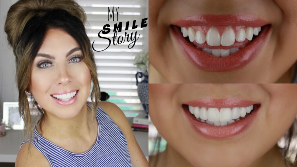 Veneers At Home