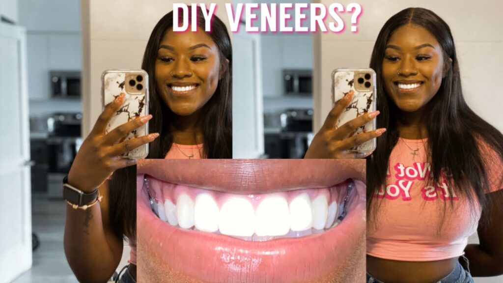 Veneers At Home