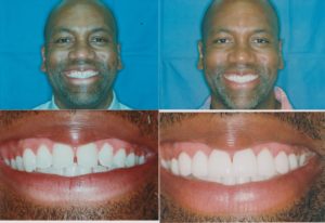 Veneers Chicago Veneers Chicago