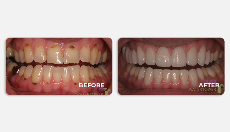 Veneers Chicago Veneers Chicago