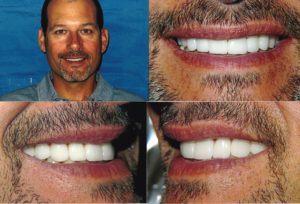 Veneers Cost Chicago Veneers Cost Chicago