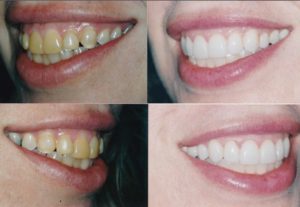 Veneers Cost Chicago Veneers Cost Chicago