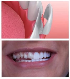Veneers Cost Per Tooth