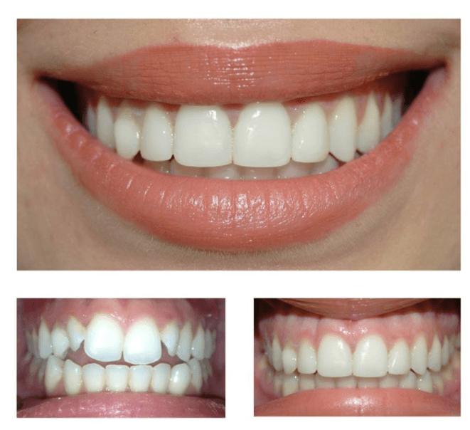 Veneers Cost Per Tooth