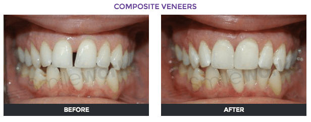 Veneers Cost Per Tooth