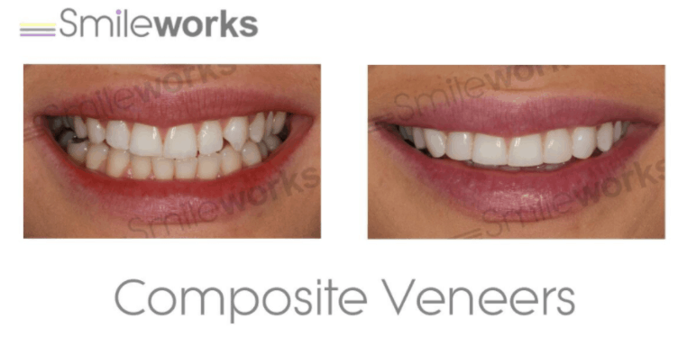 Veneers Cost Per Tooth