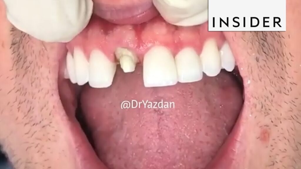 Veneers Process