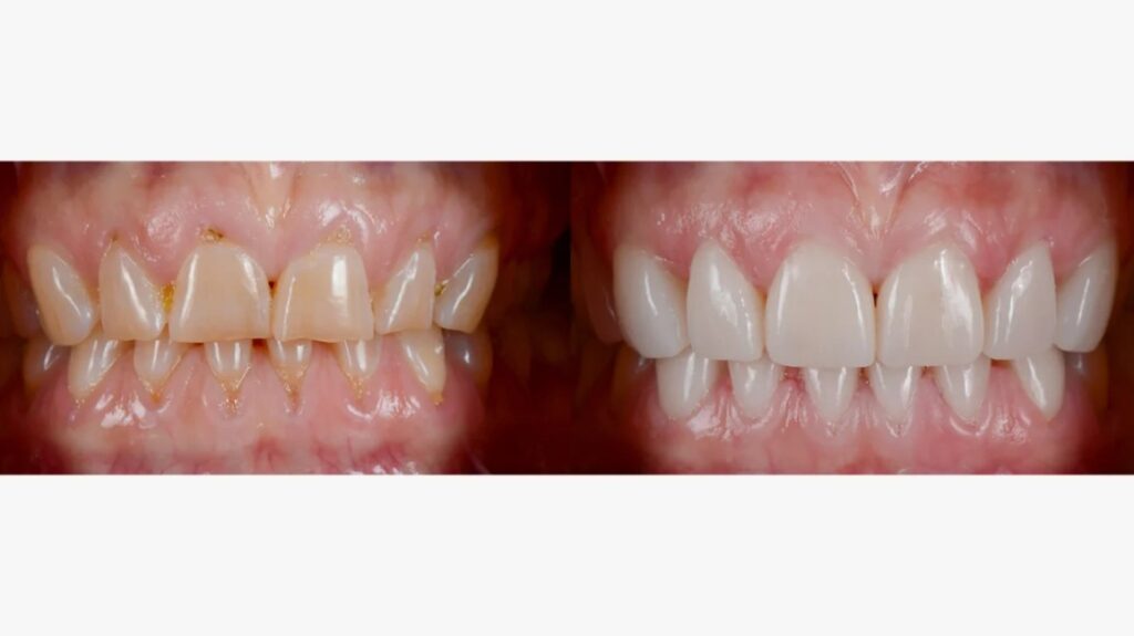 Veneers Teeth Cost