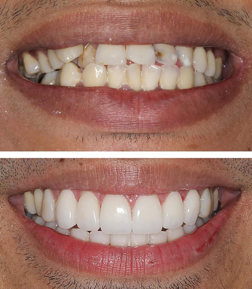 Veneers Teeth Meaning