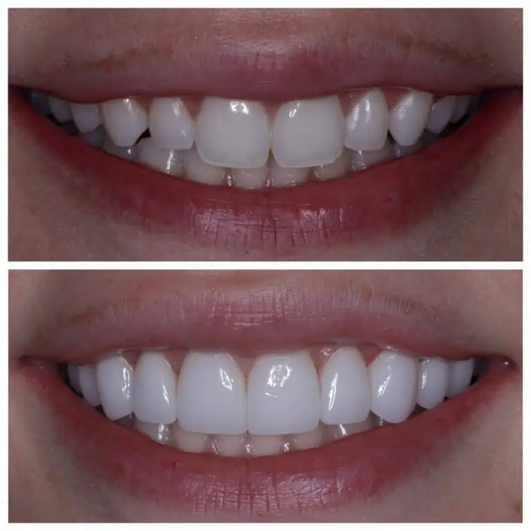 Veneers Teeth Price Veneers Teeth Price