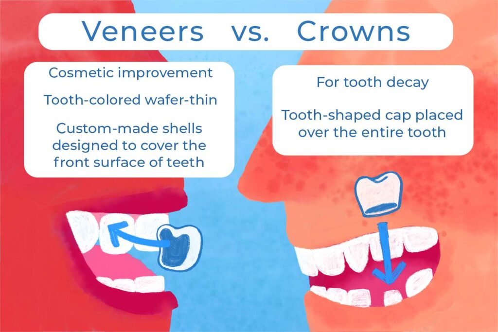 Veneers Vs Crowns
