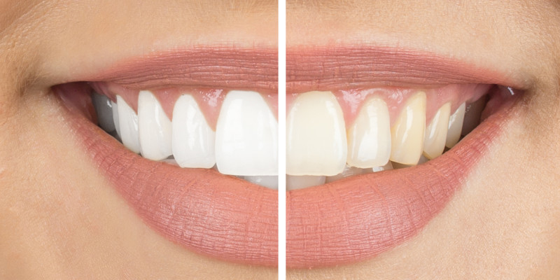 Cosmetic Dentist In Winston Salem North Carolina Cosmetic Dentist In Winston Salem North Carolina
