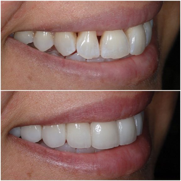 Cosmetic Dentist In Adams Hill Glendale California Calif CA