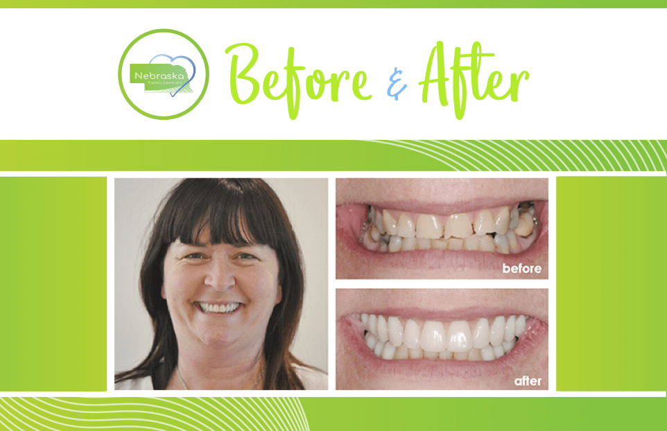 Cosmetic Dentist In Antelope Park Lincoln Nebraska Neb NE
