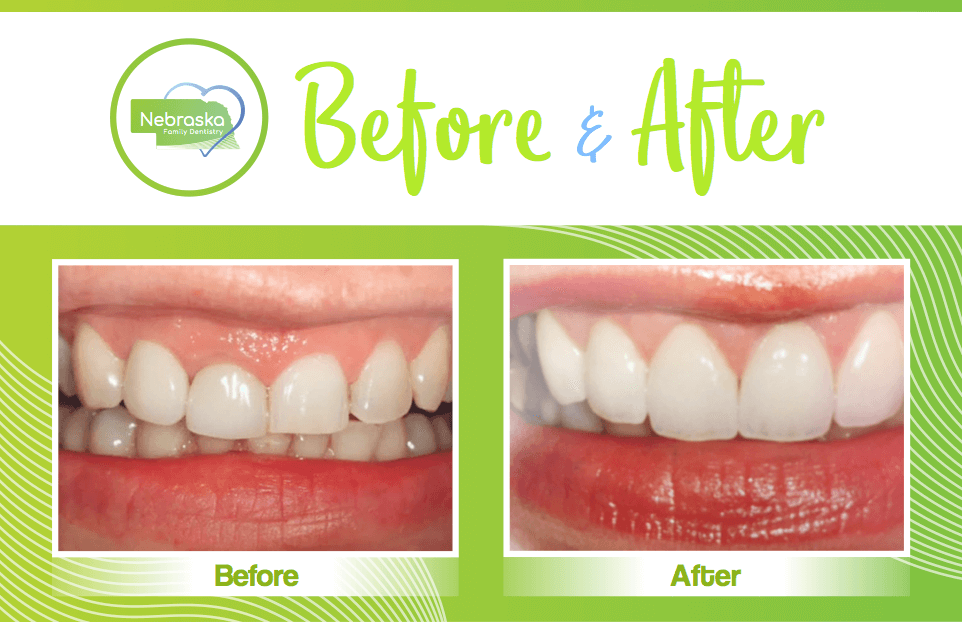Cosmetic Dentist In Antelope Park Lincoln Nebraska Neb NE