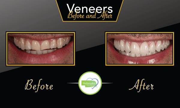 Cosmetic Dentist In Antelope Park Lincoln Nebraska Neb NE