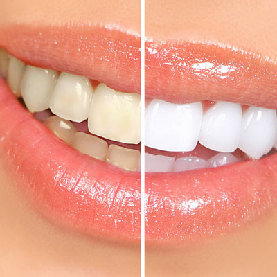 Cosmetic Dentist In Benton Park St Louis Missouri MO