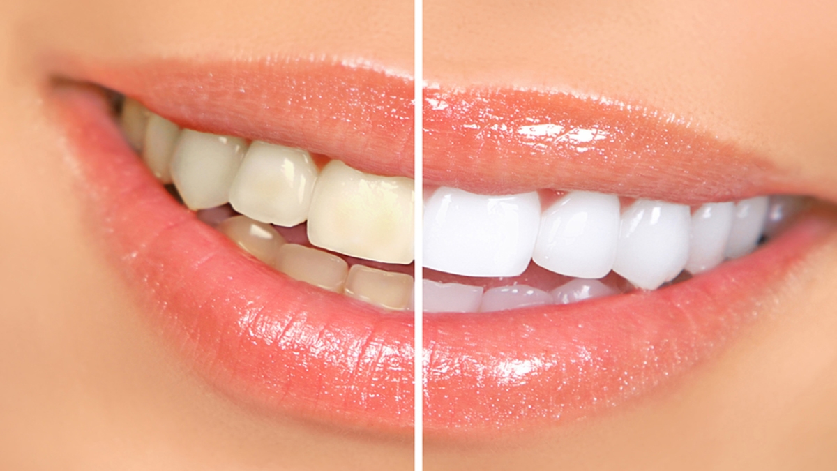 Cosmetic Dentist In Berryessa San Jose California Calif CA