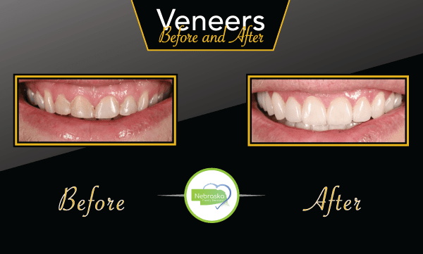 Cosmetic Dentist In Capitol Beach Lincoln Nebraska Neb NE