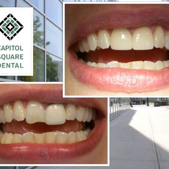 Cosmetic Dentist In Capitol Square Madison Wisconsin Wis WI