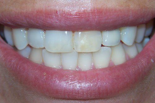 Cosmetic Dentist In Catoosa Adjacent To Tulsa Oklahoma Okla OK