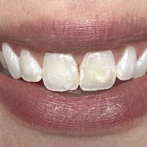 Cosmetic Dentist In Cheesman Park Denver Colorado Colo CO