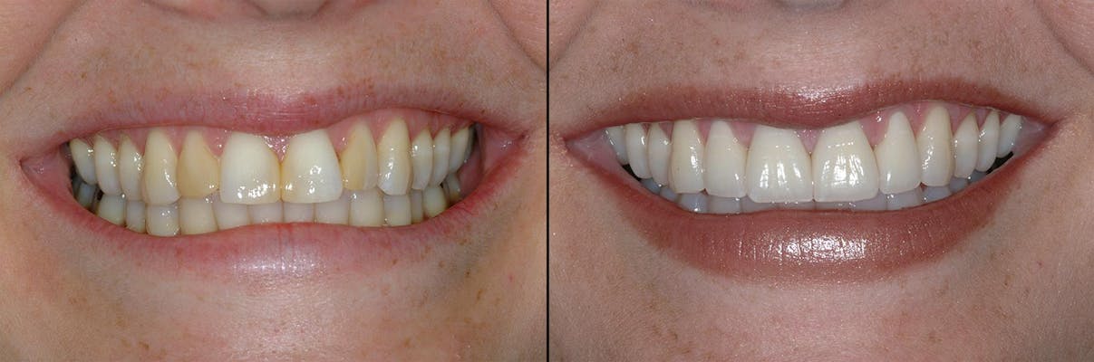 Cosmetic Dentist In Cheesman Park Denver Colorado Colo CO