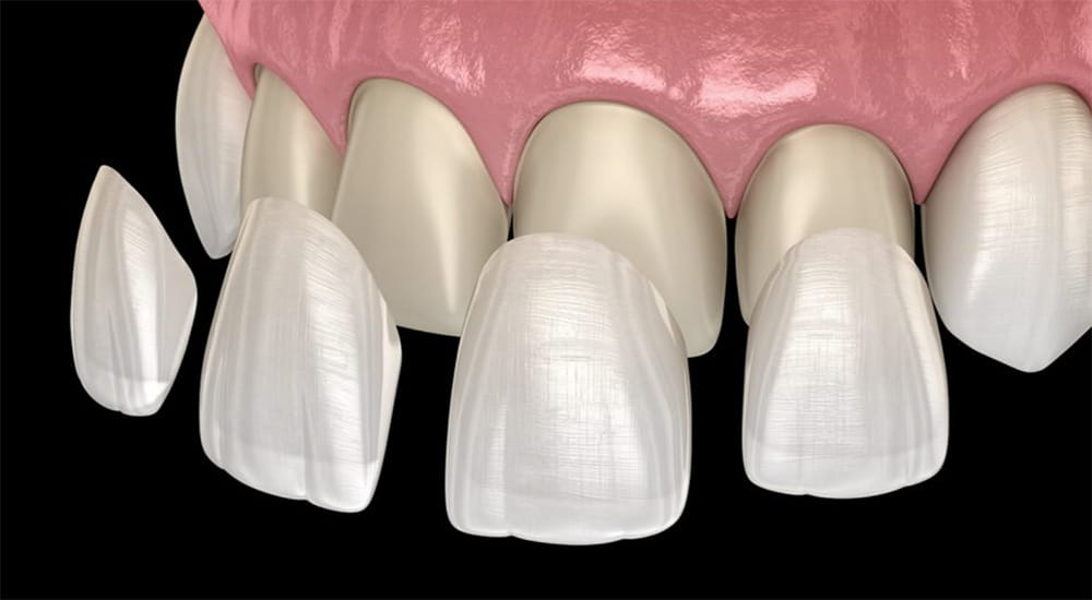 Cosmetic Dentist In Cherry Creek State Park Area Centennial Colorado Colo CO Cosmetic Dentist In Cherry Creek State Park Area Centennial Colorado Colo CO