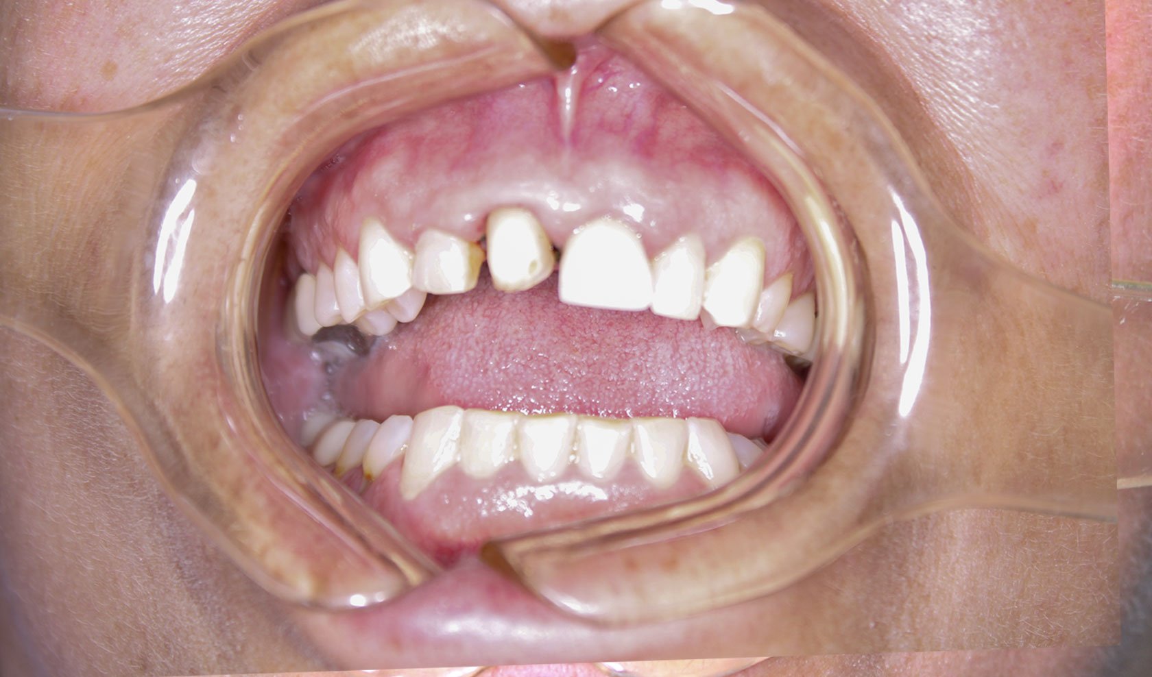 Cosmetic Dentist In Clear Lake/NASA Houston Texas TX Cosmetic Dentist In Clear Lake/NASA Houston Texas TX
