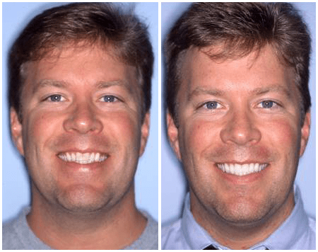 Cosmetic Dentist In Columbia Tusculum Cincinnati Ohio OH