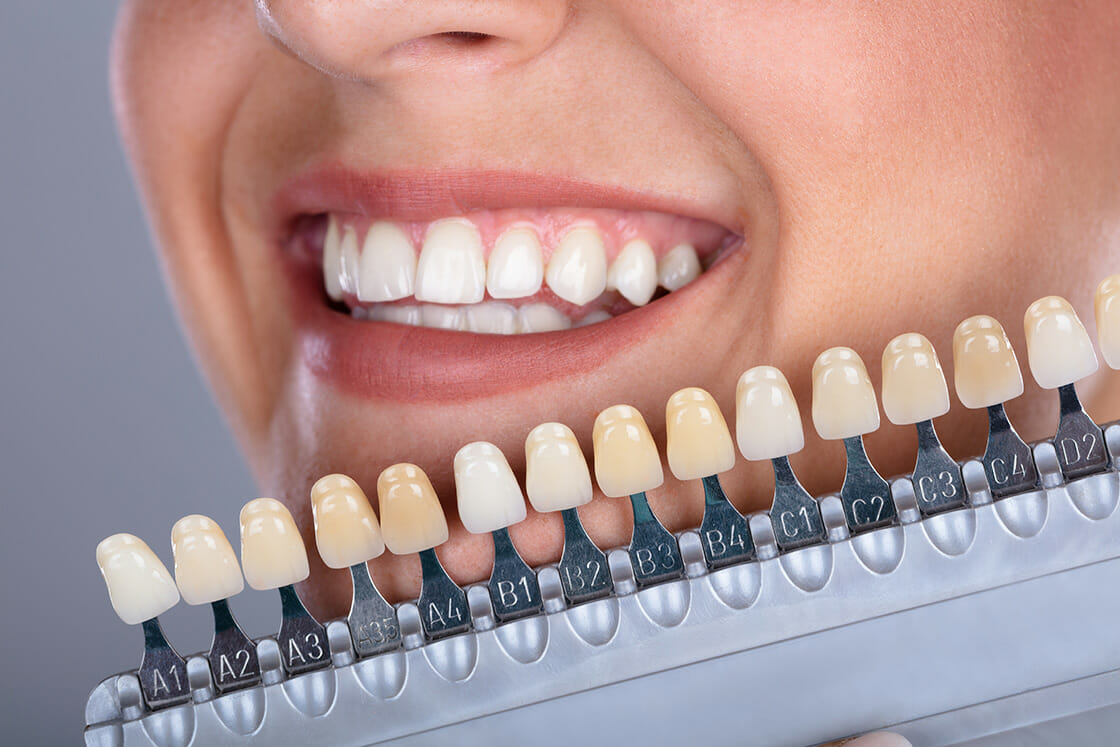Cosmetic Dentist In Columbia Tusculum Cincinnati Ohio OH