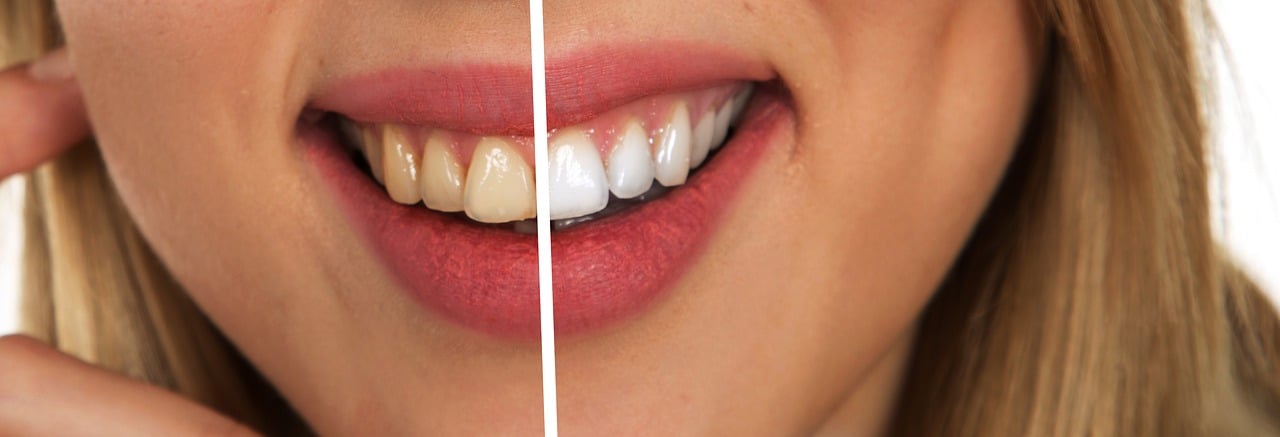 Cosmetic Dentist In Duke University Area Durham North Carolina NC Cosmetic Dentist In Duke University Area Durham North Carolina NC