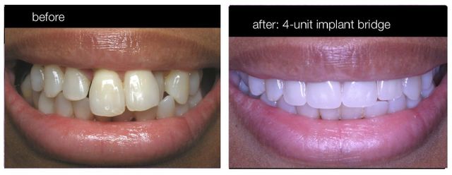 Cosmetic Dentist In Englewood Denver Colorado Colo CO