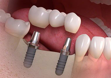 Cosmetic Dentist In Glenwood Yonkers New York NY Cosmetic Dentist In Glenwood Yonkers New York NY