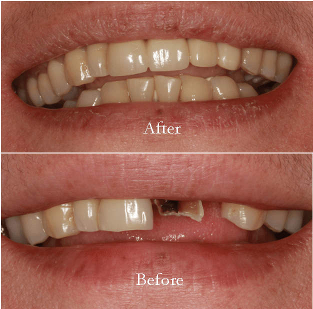 Cosmetic Dentist In Hillside Terrace Amarillo Texas TX