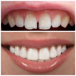 Cosmetic Dentist In Lewisville Adjacent To Winston Salem North Carolina NC Cosmetic Dentist In Lewisville Adjacent To Winston Salem North Carolina NC