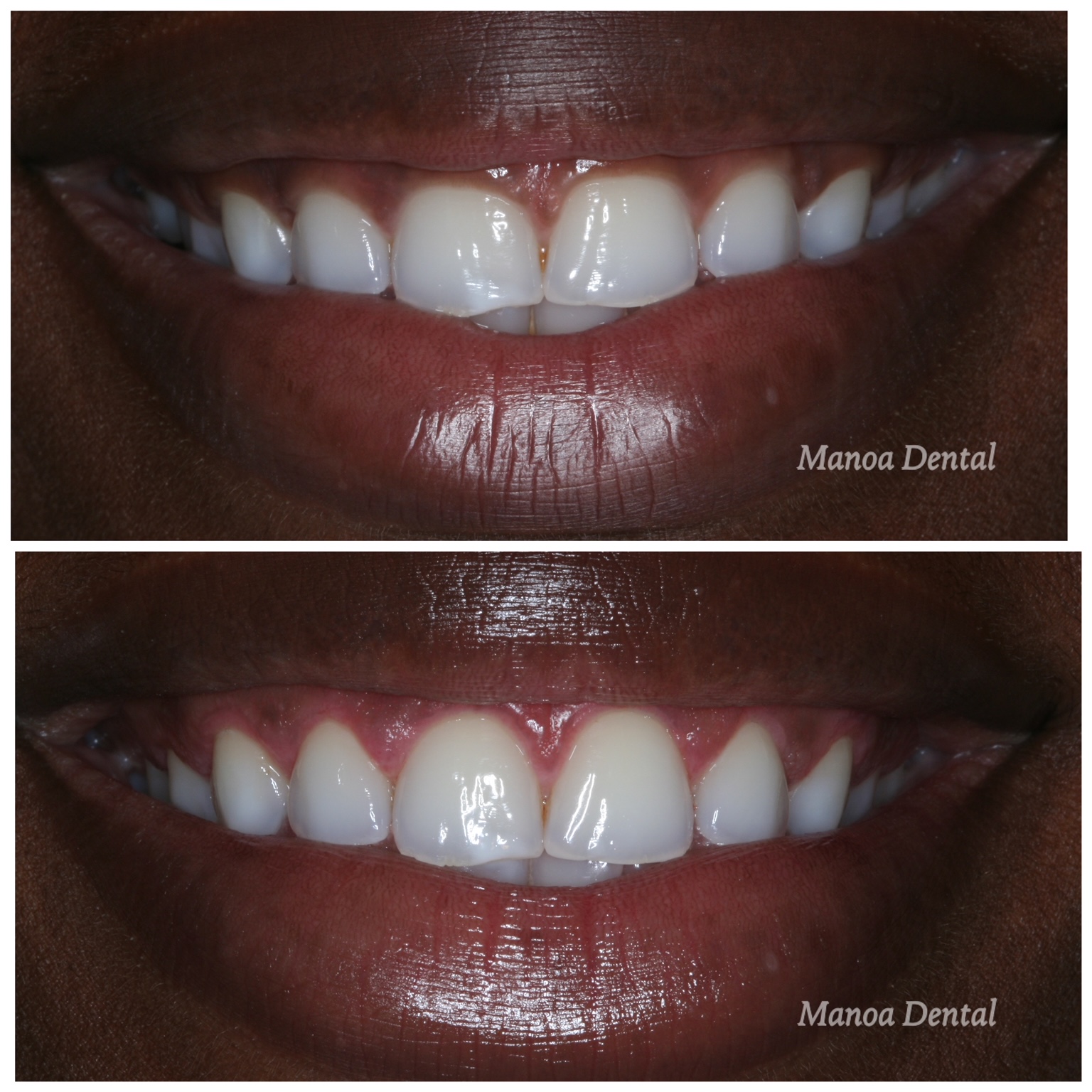 Cosmetic Dentist In Manoa Honolulu Hawaii HI Cosmetic Dentist In Manoa Honolulu Hawaii HI