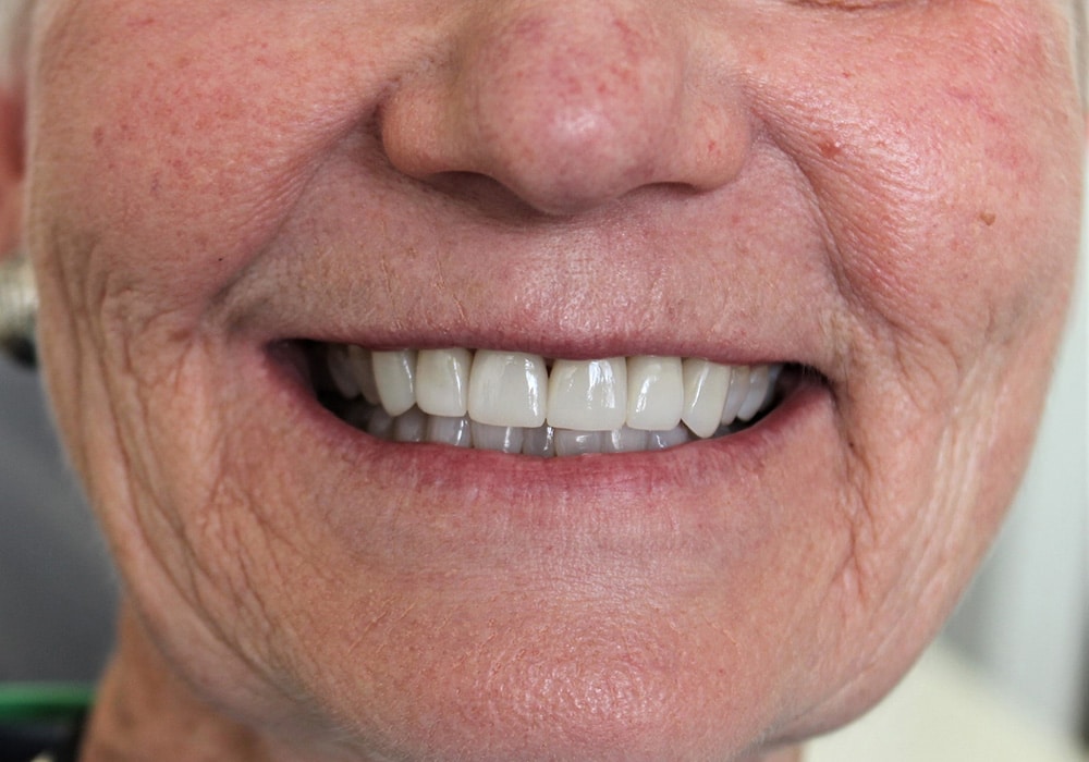 Cosmetic Dentist In Mesa Junction Pueblo Colorado Colo CO Cosmetic Dentist In Mesa Junction Pueblo Colorado Colo CO