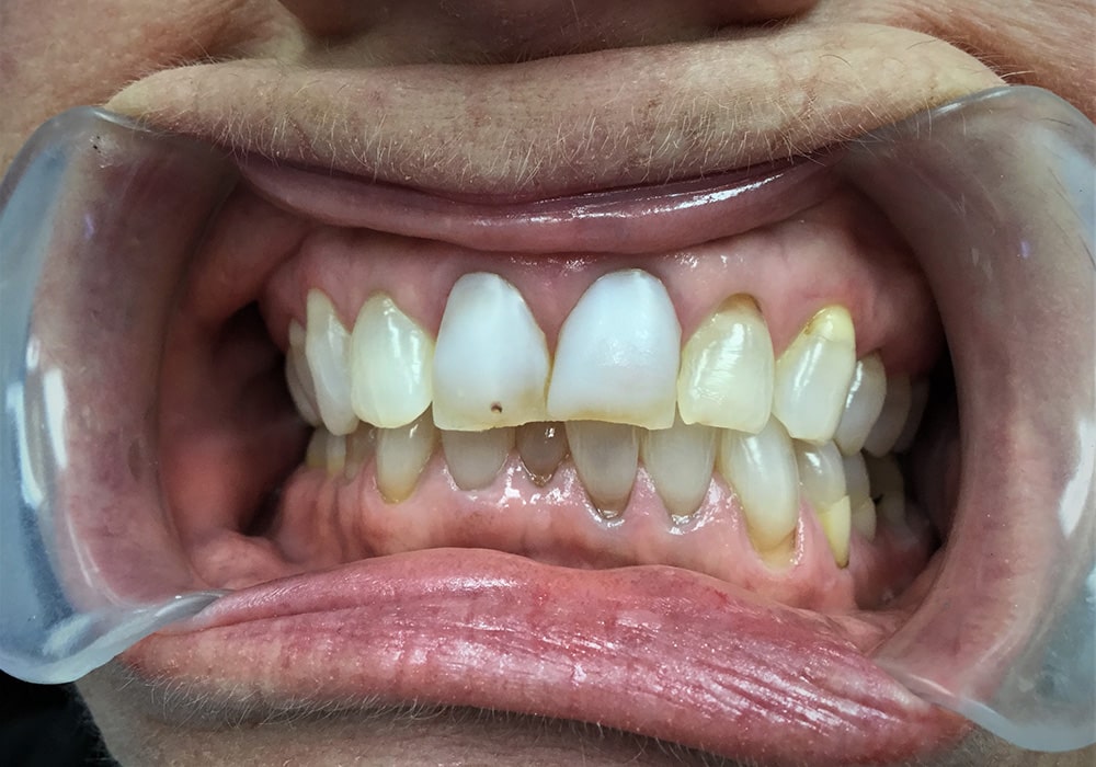 Cosmetic Dentist In Mesa Junction Pueblo Colorado Colo CO Cosmetic Dentist In Mesa Junction Pueblo Colorado Colo CO