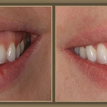 Cosmetic Dentist In Mt. Lebanon Adjacent To Pittsburgh Pennsylvania PA