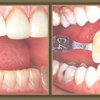 Cosmetic Dentist In Mt. Lebanon Adjacent To Pittsburgh Pennsylvania PA